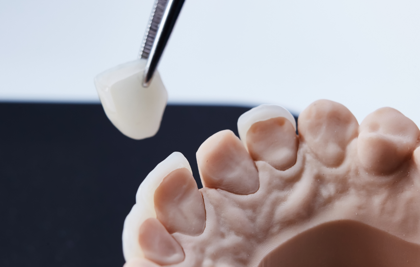 dental_veneers_Edmonton_dentist